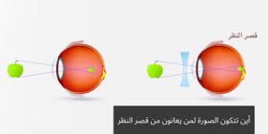 أين تتكون الصور لمن يعاني من قصر النظر