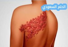 هل الحزام الناري معدي؟ كل ما تحتاج معرفته عن العدوى والوقاية