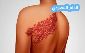 هل الحزام الناري معدي؟ كل ما تحتاج معرفته عن العدوى والوقاية 