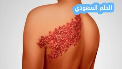 هل الحزام الناري معدي؟ كل ما تحتاج معرفته عن العدوى والوقاية