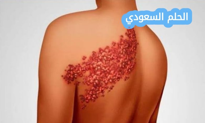 هل الحزام الناري معدي؟ كل ما تحتاج معرفته عن العدوى والوقاية